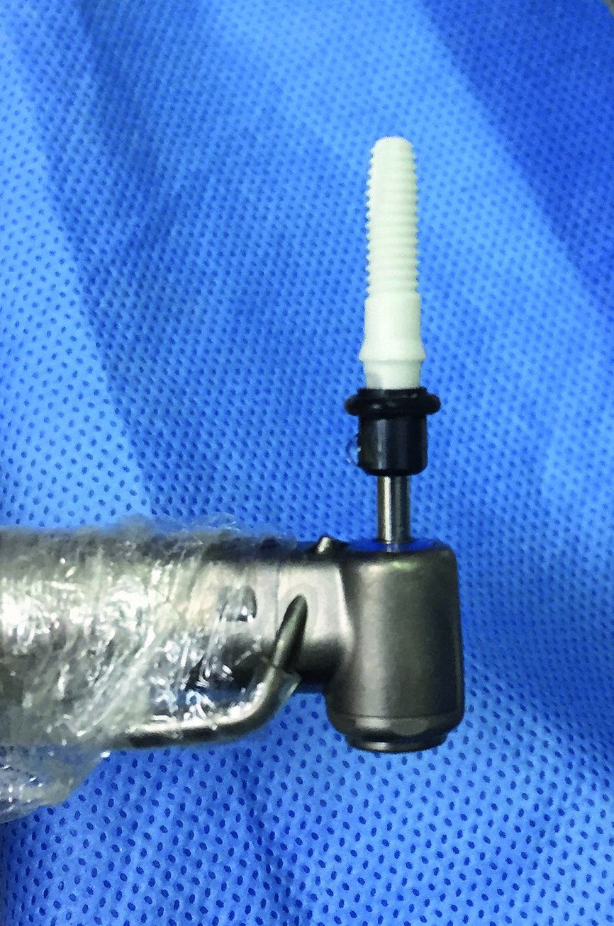 Figs. 3a–c : Implant ZiBone monobloc en zircone (Ø 4,0 mm, longueur 12,0 mm).