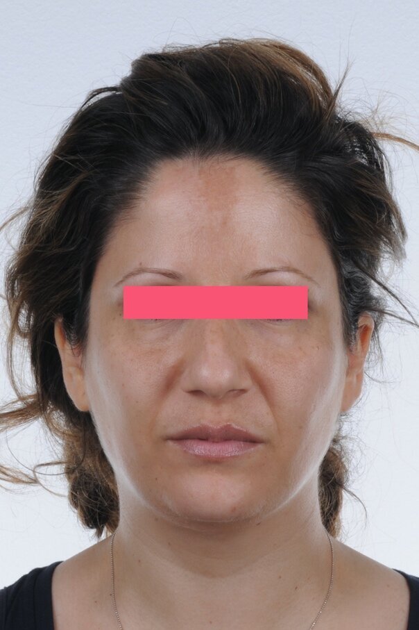 Figg. 1a-1c - Foto extraorali pre-trattamento: visioni frontale, frontale del sorriso e laterale.