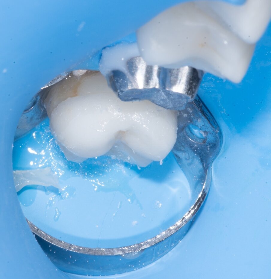 Fig. 16: Final polymerisation under glycerine gel.