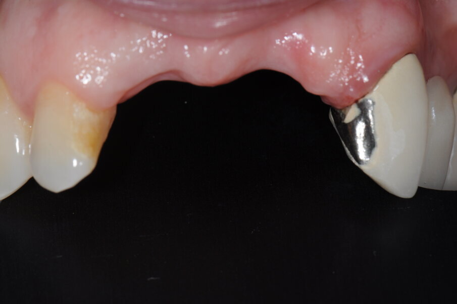 Fig. 7 - Visione frontale dopo avulsione elemento 1.1.