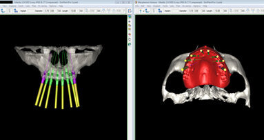 Restauro immediato nel mascellare totalmente edentulo