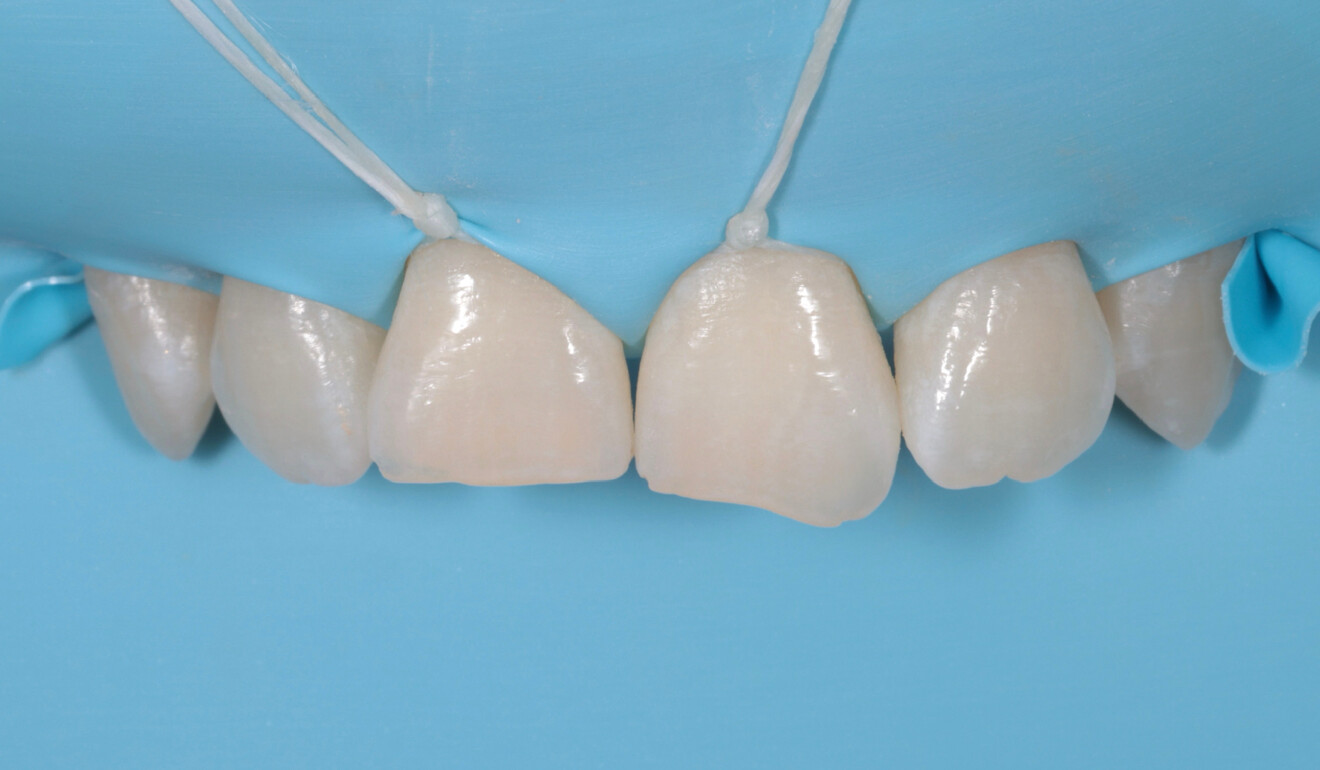 Fig. 5: Operative field isolated using a dental dam.