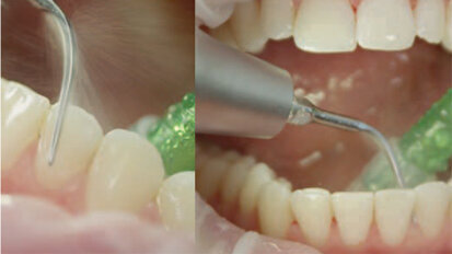 Guided Biofilm Therapy: A New Concept for Prophylaxis Professionals