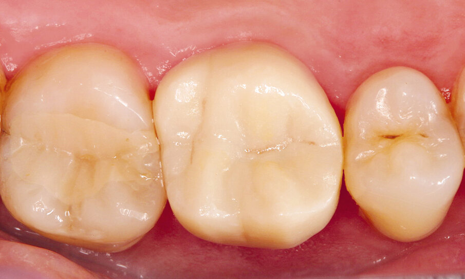 Fig. 3: Monolithic MO crown in situ
