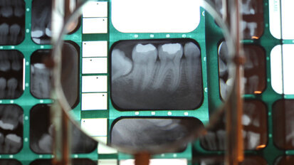 Artificial intelligence shows promise for detecting periodontal status in bitewing radiographs