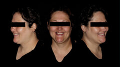 One-year follow-up of Straumann Fast Molar Solution in bilateral maxillary premolars