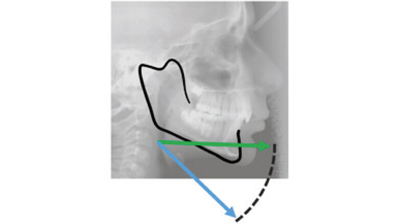 Moderate to severe Class II  malocclusion using Invisalign® treatment with mandibular advancement