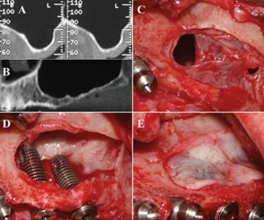 Figs. 10a-e: PRF is used in invasive surgery.