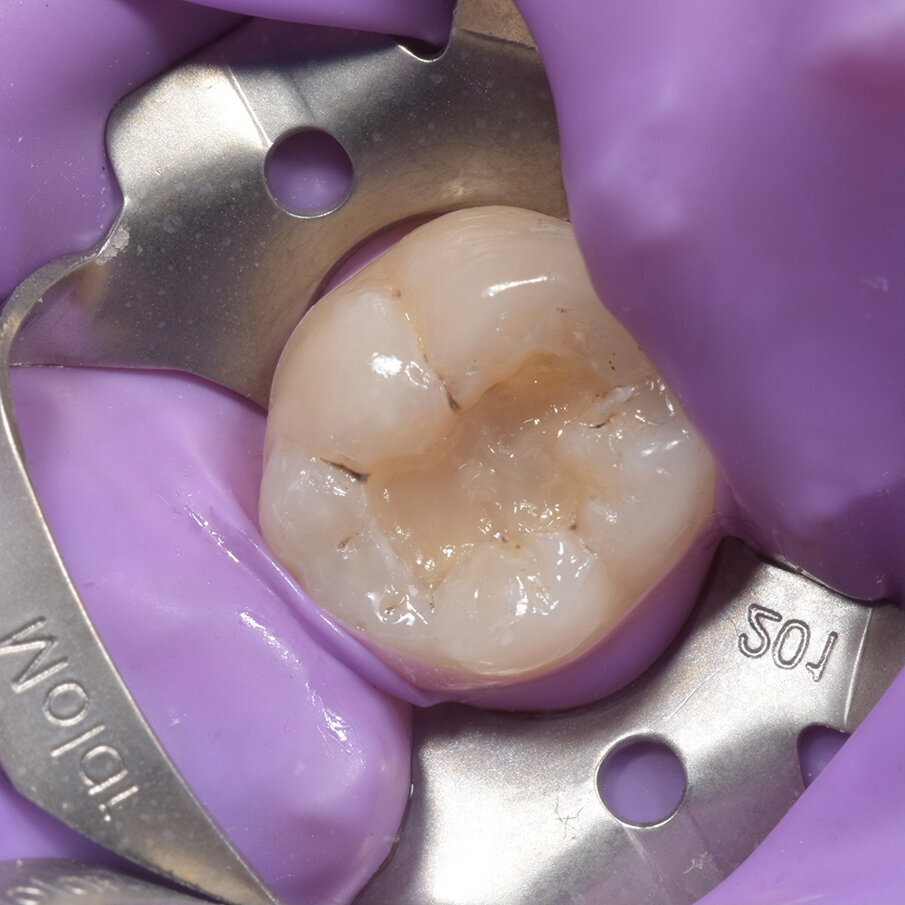 Fig 8: Build-up of final layer with Beautifil IILS shade A3  