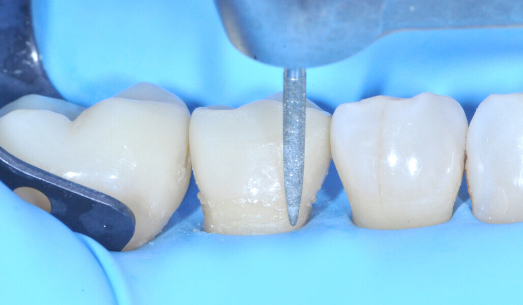 Fig. 24: Finishing of the interproximal areas with an EVA handpiece. 