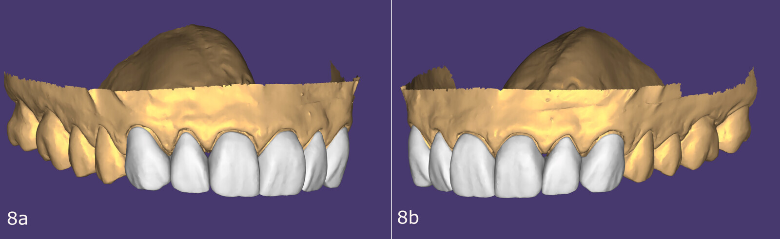 Figs. 8a & b: Anterior wax-up.