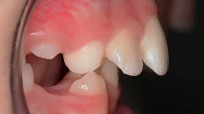 Pre-orthodontic options for 21st century parents Pre-orthodontic options for 21st century parents