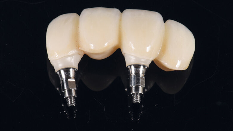 Okamžitá implantace a CAD/CAM rekonstrukce v estetické zóně