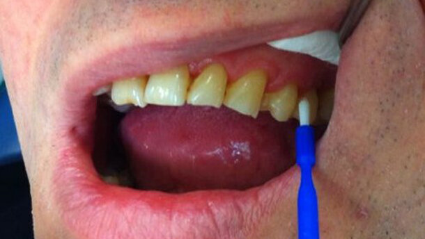 Trattamento dell’ipersensibilità dentinale