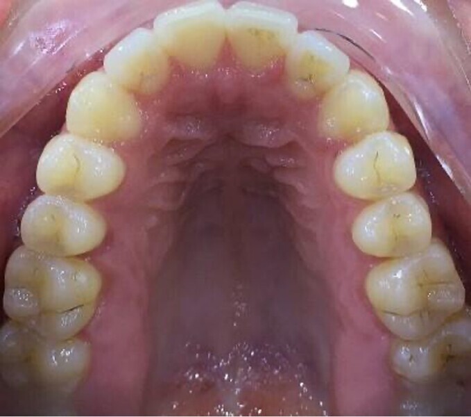 Fig. 31: Occlusal view of the maxillary arch after aligner treatment.