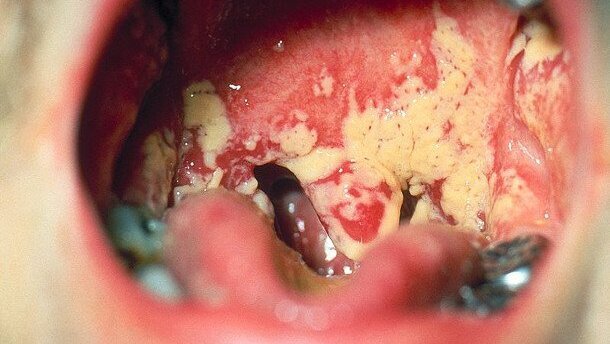 Учените са открили микроорганизъм, който предотвратява оралните инфекции