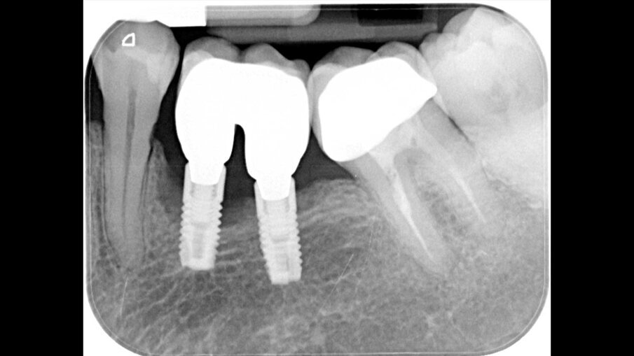 Fig. 1 - Radiografia iniziale che evidenzia la perimplantite in zona 3.5 e 3.6.