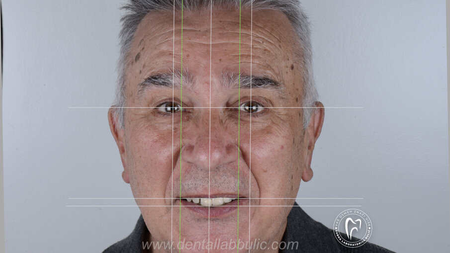 Slika 1 Slike inicijalnog stanja pacijenta sa linijskom analizom 
(Zubna laboratorija Bulić)