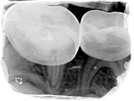 Afbeelding 3c: Röntgenfoto's op de leeftijd van 6 jaar, juli 2018.