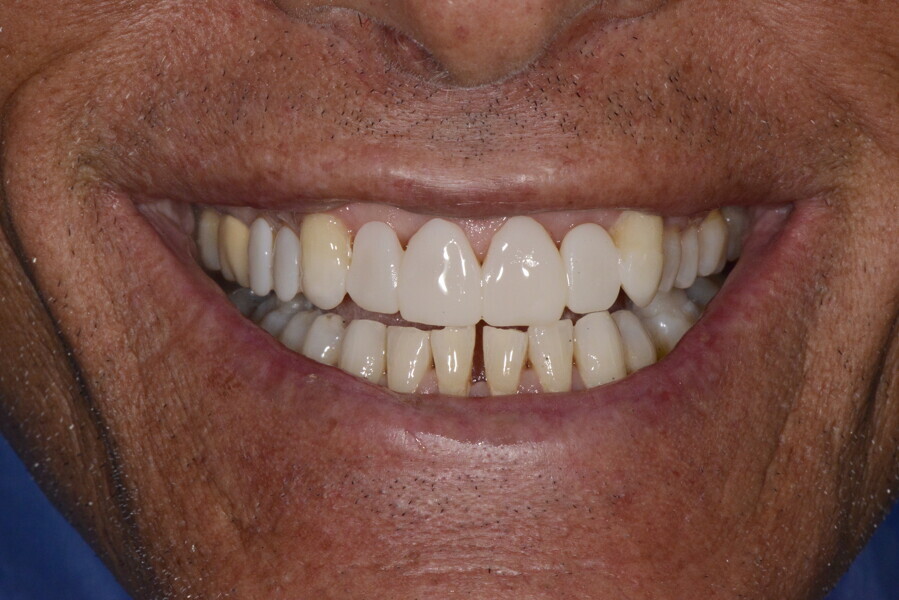 Figs. 15a–c: Direct mock-up to help the patient understand the functional and aesthetic problems and view the augmented vertical dimension of occlusion with the jaws held in centric relation with a posterior stop.