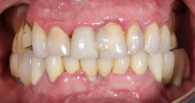 Novel digital workflow for full-arch rehabilitation