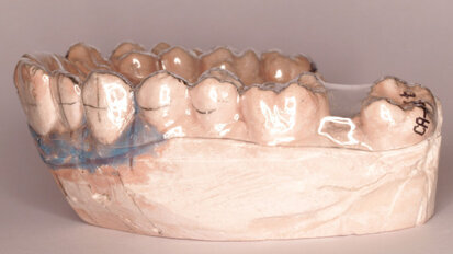 Protocolo de tratamiento de CA® CLEAR-ALIGNER en uno, dos o tres pasos a partir de mismo modelo