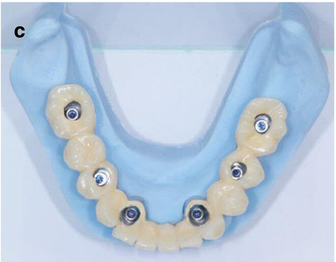 Fig. 7c: CAD/CAM model with the prefabricated titanium abutments (a), CAD/CAM cobalt–chromium framework (b) and composite veneered provisional FDP (c & d) before bonding to the abutments.