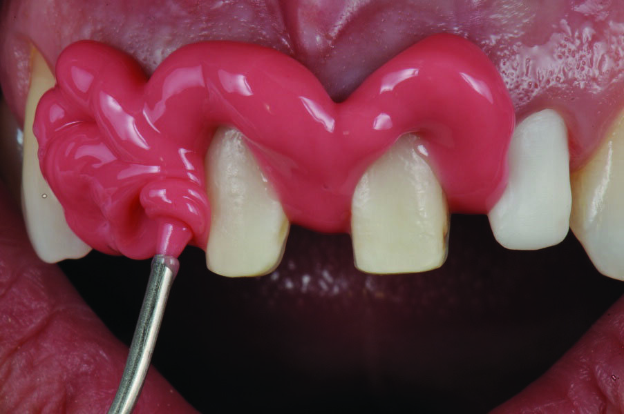 Fig. 4: Application of 3M™ Impregum™ L DuoSoft™ Polyether Light Body Impression material keeping tip well immersed.