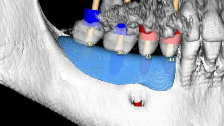 Horizontální augmentace hřebene a implantace: Dvoufázová procedura GBR