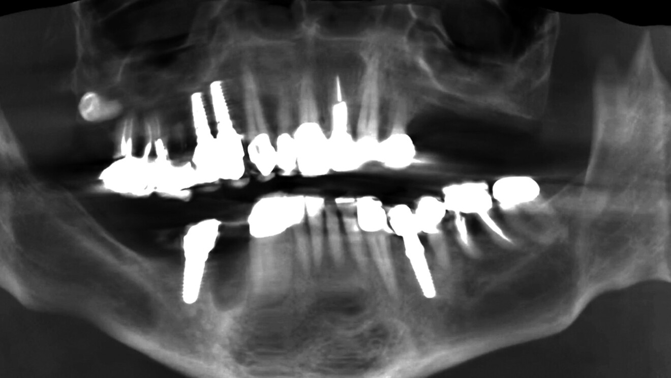 Fig. 2: Pre-op CBCT-generated panoramic radiograph showing missing teeth, pre-existing implants and crowns, fractured teeth and previous root canal treatment.