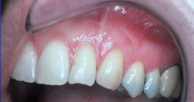 Cosmetic periodontal surgery: Multiple gingival graft techniques (Part 2)