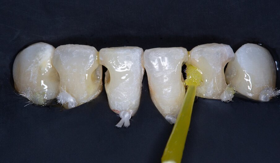 Fig. 4: Application of CLEARFIL Universal Bond Quick.