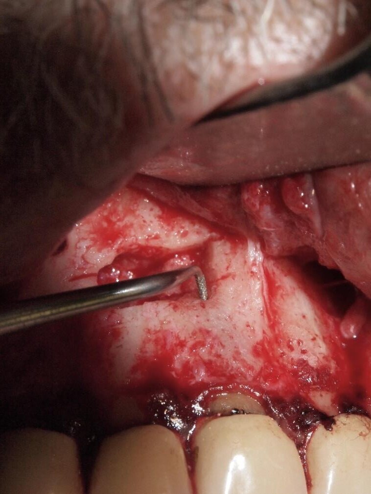 Fig. 7 - Inserto per preparazione retrograda in endodonzia chirurgica.