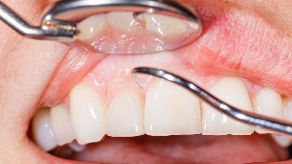 Дълбоките пародонтални джобове застрашават оралното здраве