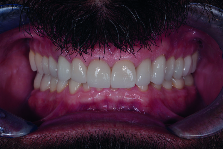 Figs. 16 et 17 : Photos de suivi en janvier 2021 montrant un résultat très stable sans aucun écaillage de la céramique et des avantages mécaniques constants mentionnés par le patient, tels que plus de céphalées de tension