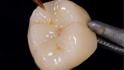 Fig. 4. Maquillaje y glaseado de la corona.