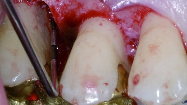 Regeneration in der Parodontaltherapie