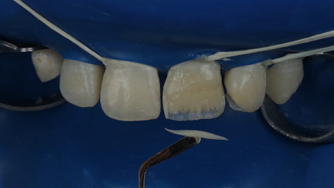 Fig 28: A2 Dentin which is opaque was used at the incisal edge to create an incisal halo.