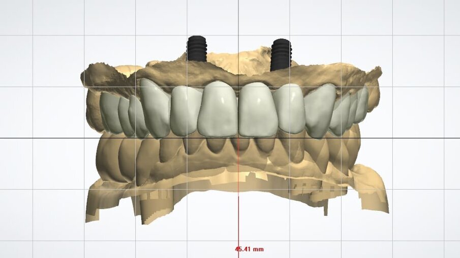 Fig. 36_Wax-up digitale funzionalizzato per entrambe le arcate in visione frontale.