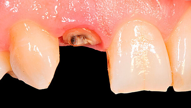 Risoluzione morfologico-estetica di un incisivo laterale: approccio mini-invasivo