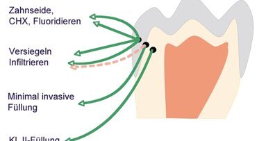 Kariestherapie im Seitenzahnbereich