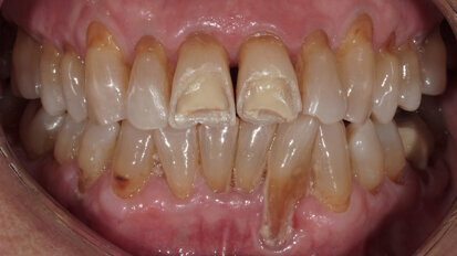 Fig. 2: Clinical situation at the initial appointment in the dental practice.