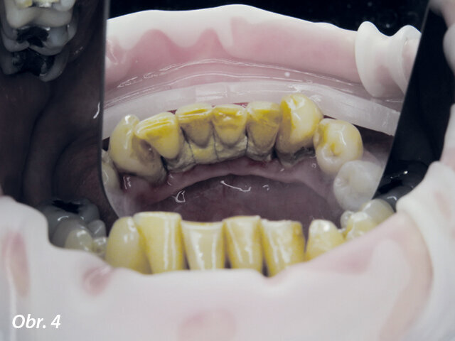 Obr. 3–5: Intraorální nález při vstupním vyšetření