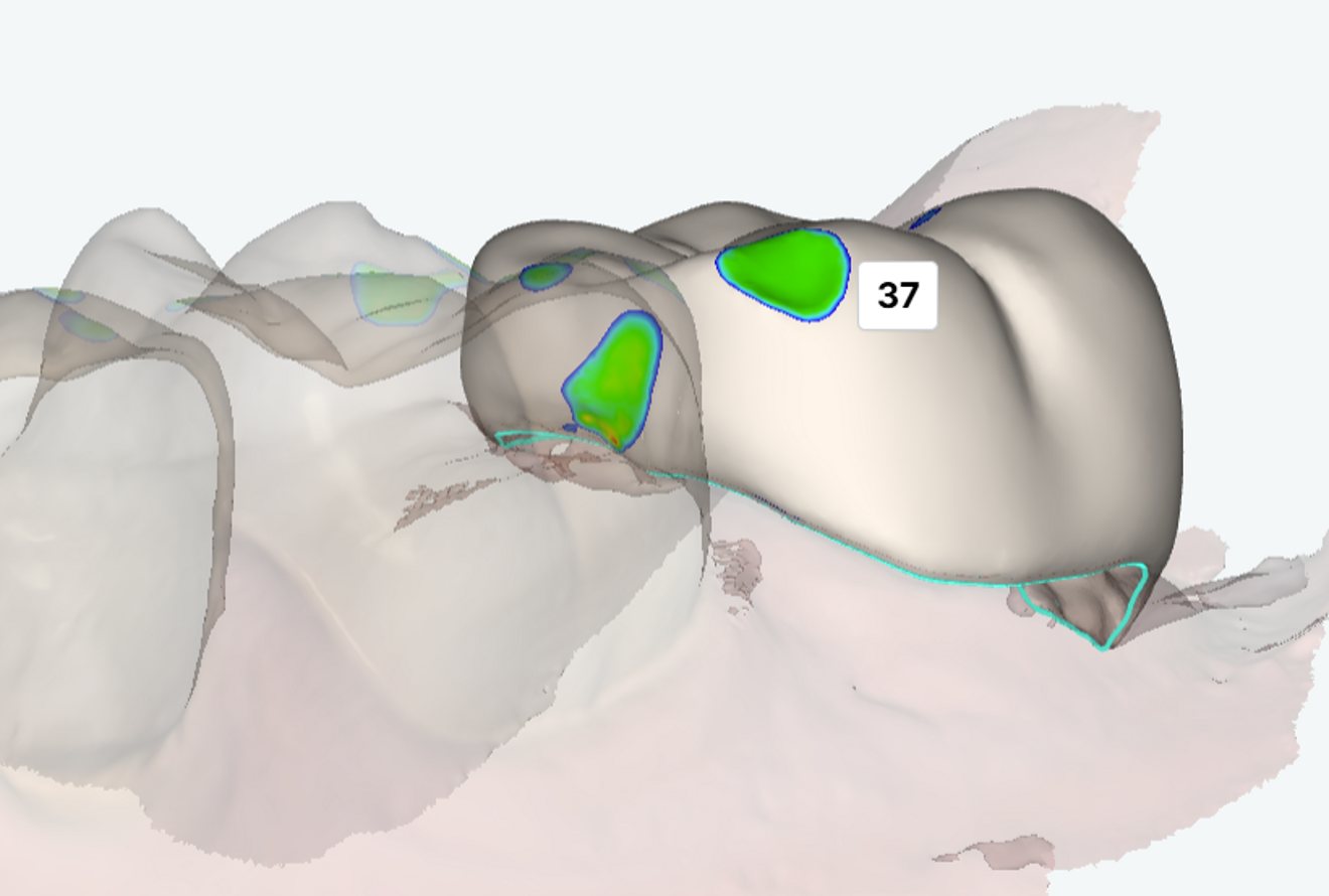 Fig. 5a: Refinement of the occlusal and proximal contacts using digital sculpting tools. Cervical contour modification to improve the path of insertion and marginal adaptation.