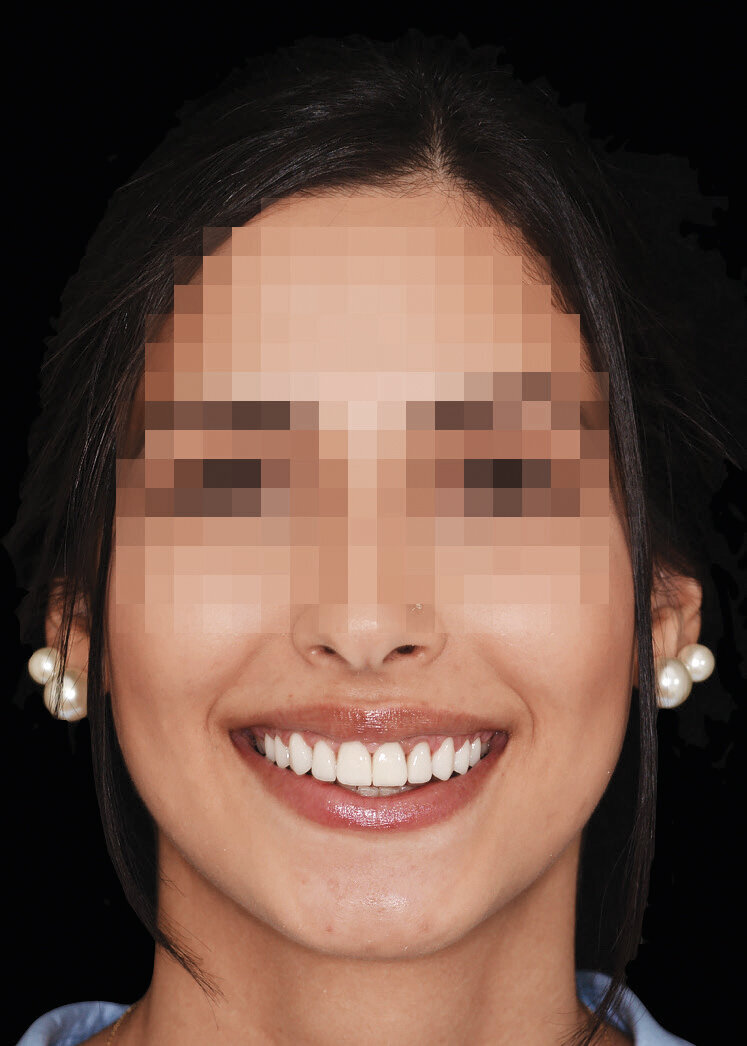 Slika 8.a-c Pričvršćivanje dviju krunica i osam ljusaka