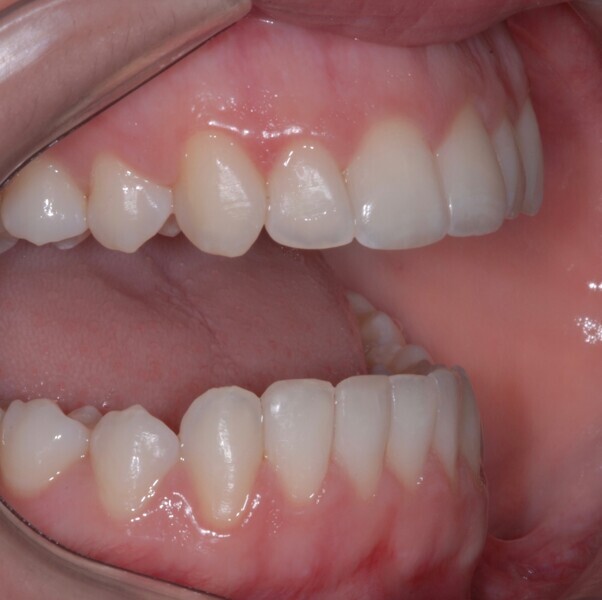 Fig. 38: Right side view with the teeth apart after treatment.