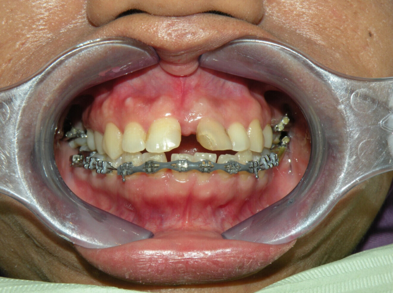Fig. 12a: Lower arch bonded first to collapse in pursue of overjet and overbite.