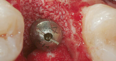 Impianti post-estrattivi immediati