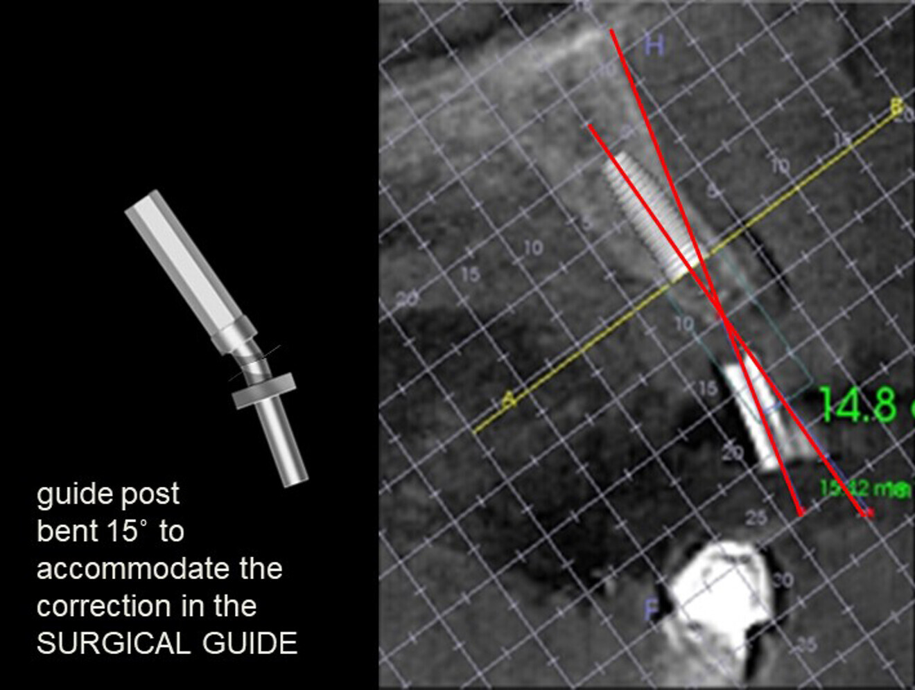 Fig. 12: Required 15° buccal angle correction of the guide post at the maxillary left lateral incisor site, accomplished with the Guide Right bending tool.