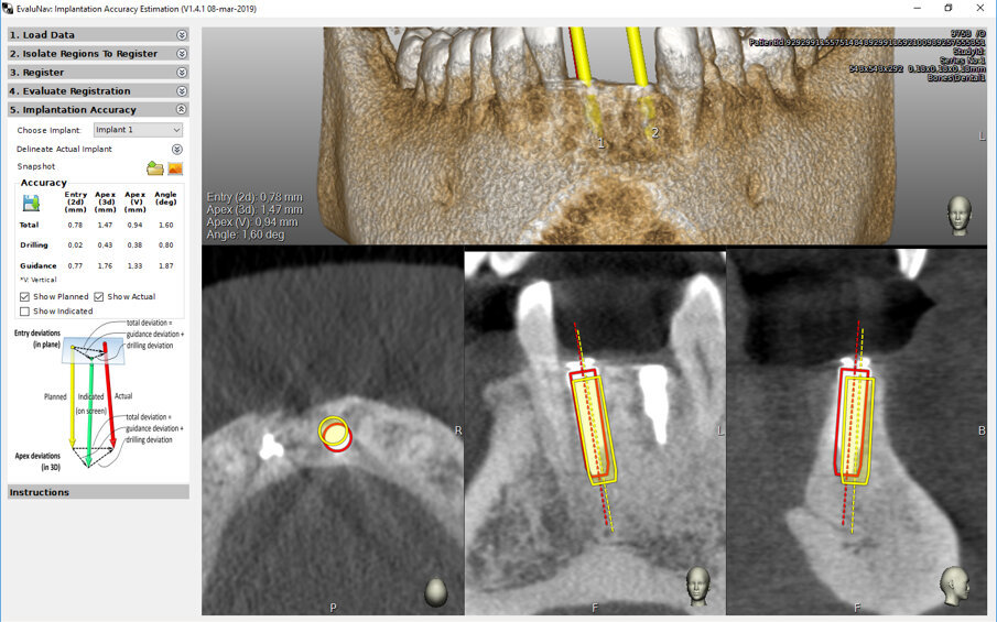 Fig. 15 - Il software Evlunav® by Claronav® per la valutazione dell’accuratezza del posizionamento implantare rispetto alla pianificazione.